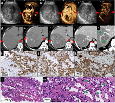 Case Report: The value of contrast-enhanced ultrasound and <mark class="highlighted">contrast-enhanced computed tomography</mark> in the diagnosis of hepatic angiosarcoma